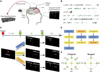 Neuronal representation of bimanual arm motor imagery in the motor cortex of a tetraplegia human, a pilot study